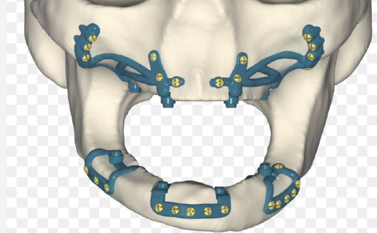 Implantes Subperiósticos