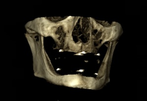 Colocación de implantes cigomáticos con regeneración simultánea para rehabilitación maxilar tras fracaso previo de implantes