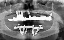 Colocación de implantes cigomáticos y convencionales para rehabilitación bimaxilar	