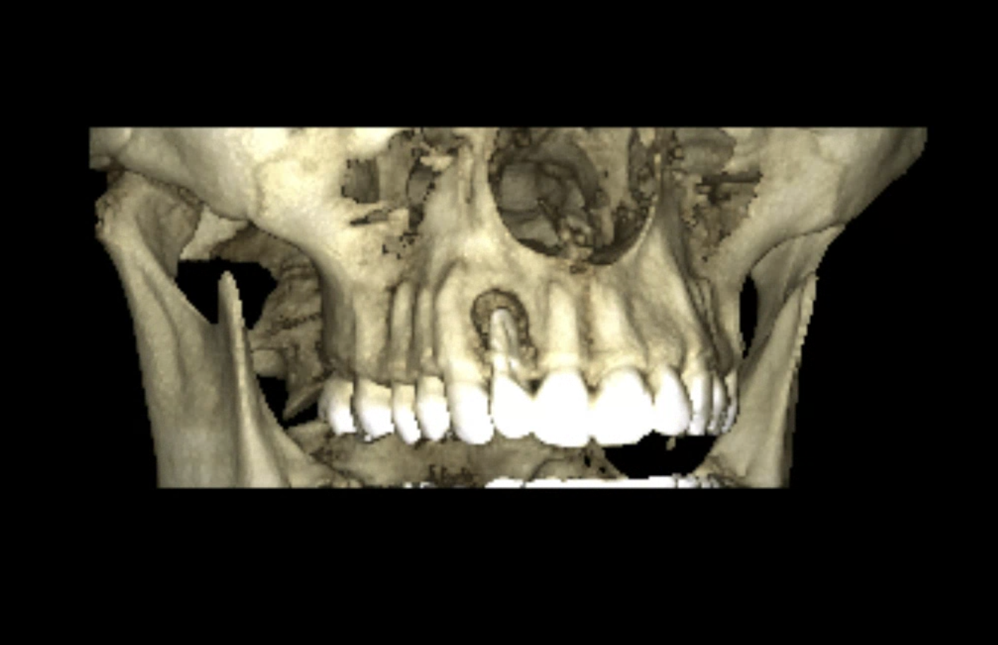 Perdida de tabla vestibular