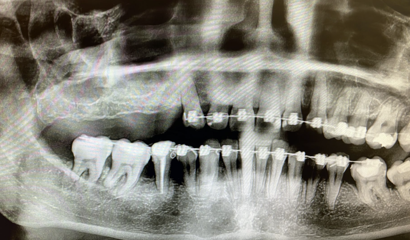 Elevación de seno en paciente con sinusitis persistente