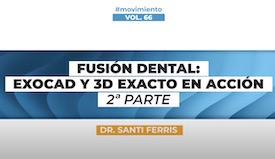 Fusion Dental: Exocad y 3D Exacto en acción PARTE 2	