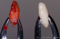 Dental autotransplantation, implants & gbr canine included to  lateral position